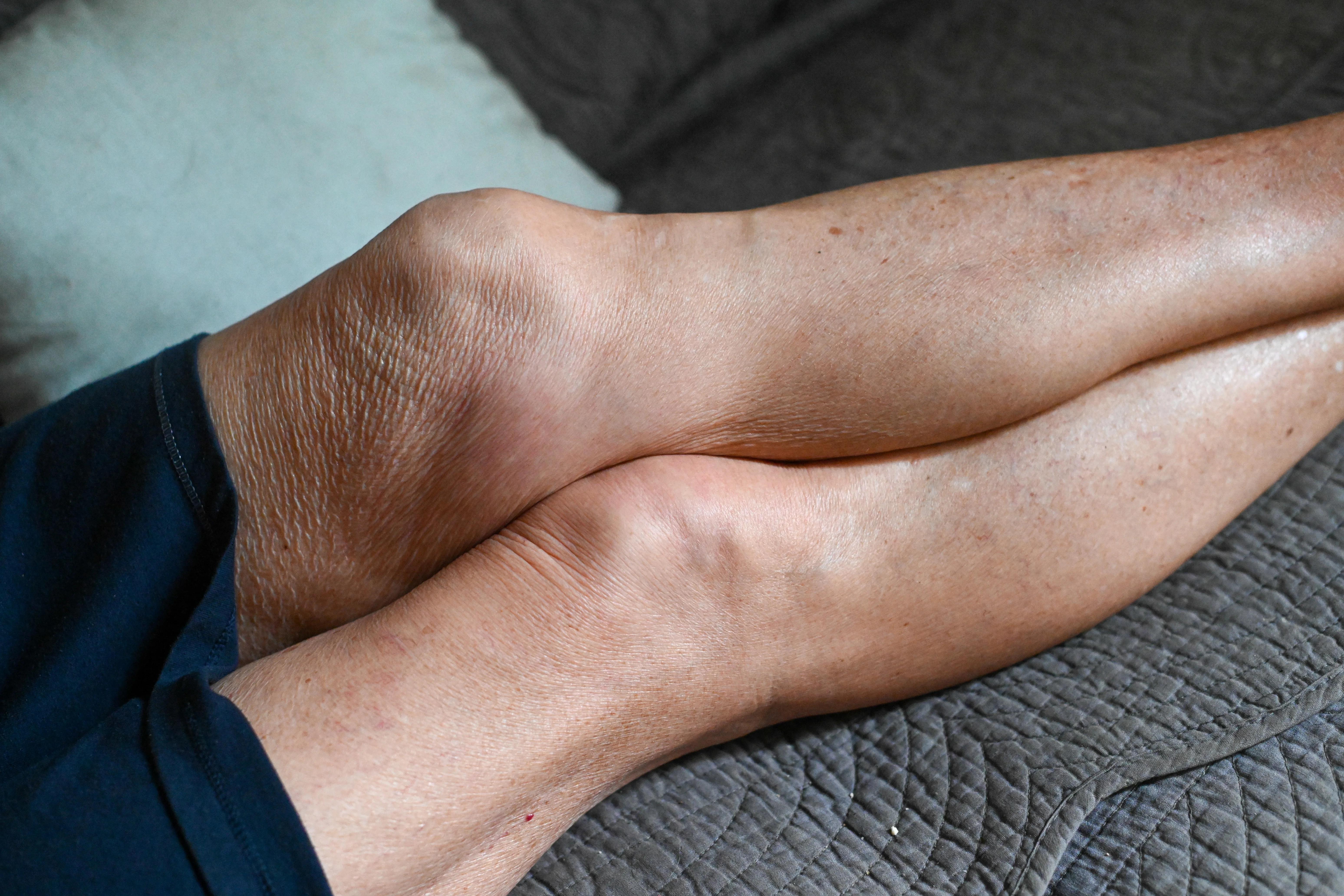 Close-up of legs showing swelling or inflammation around the knee