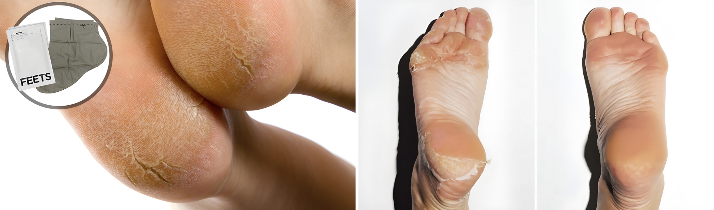 Before and after results of FEETS Foot Peel Mask on cracked heels