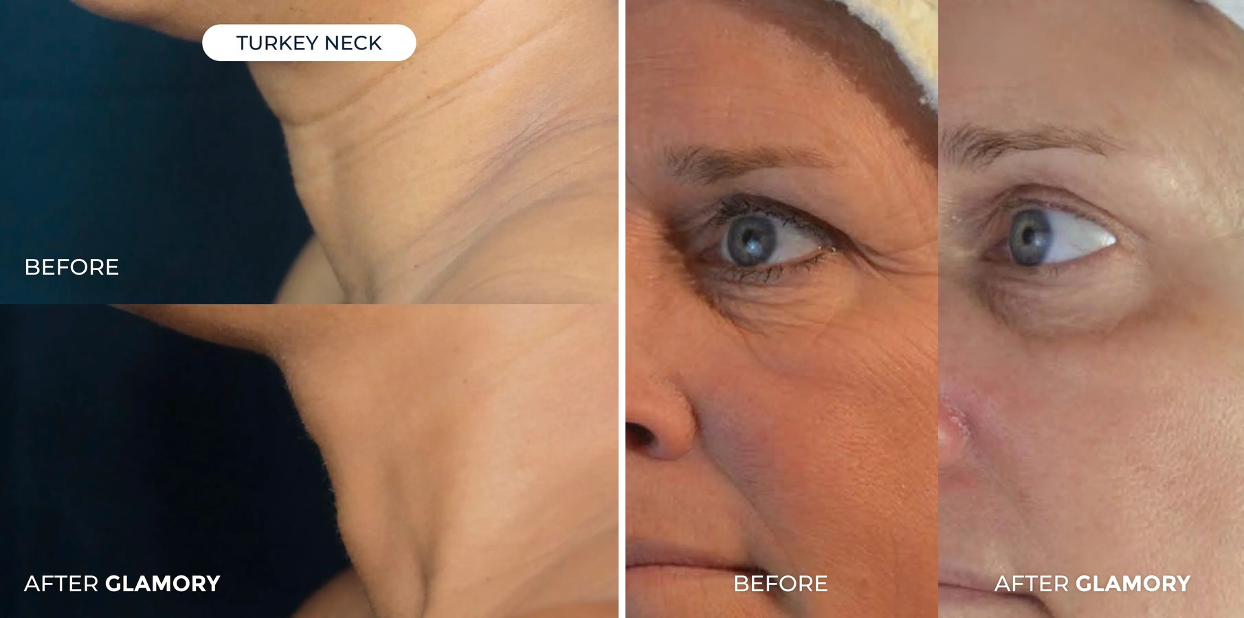 Before and after results on neck and eye area after using Glamory MicroLift