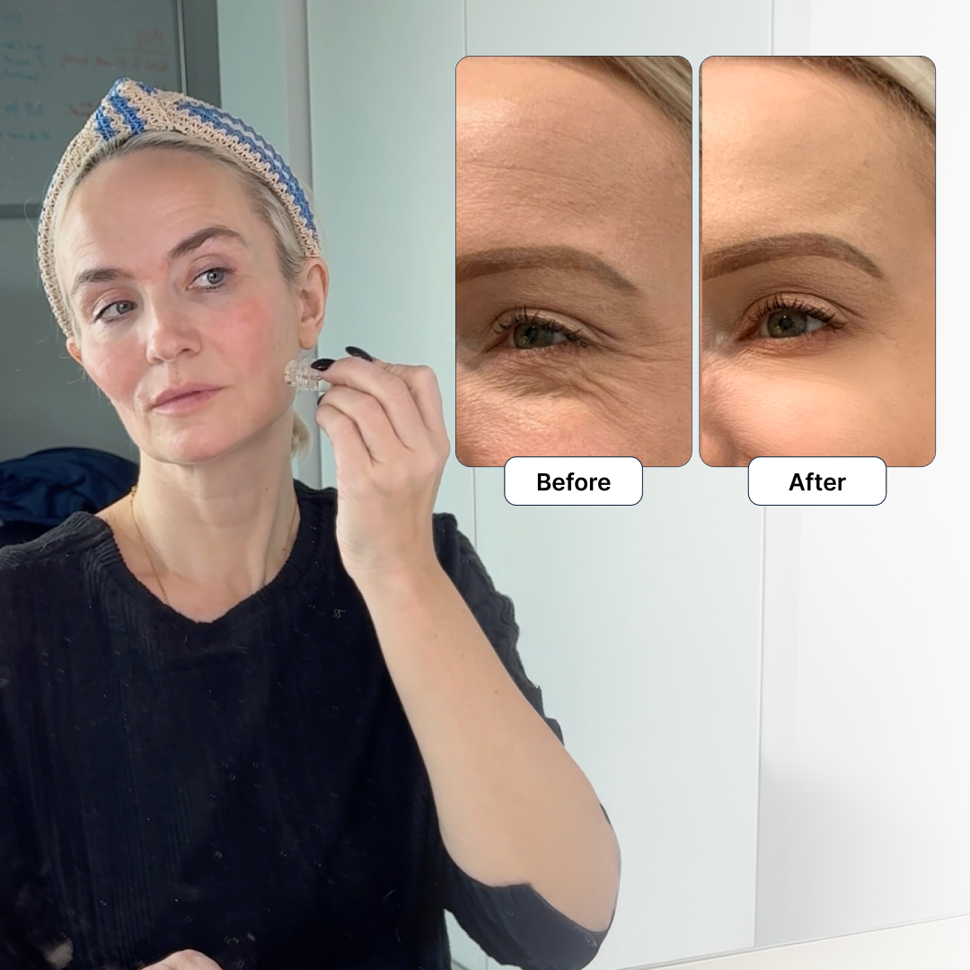 Woman using Glamory MicroLift device on her cheek with before-and-after inset
