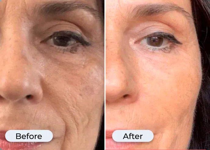 Before and after photo from Glamory's offer page showing under-eye skin