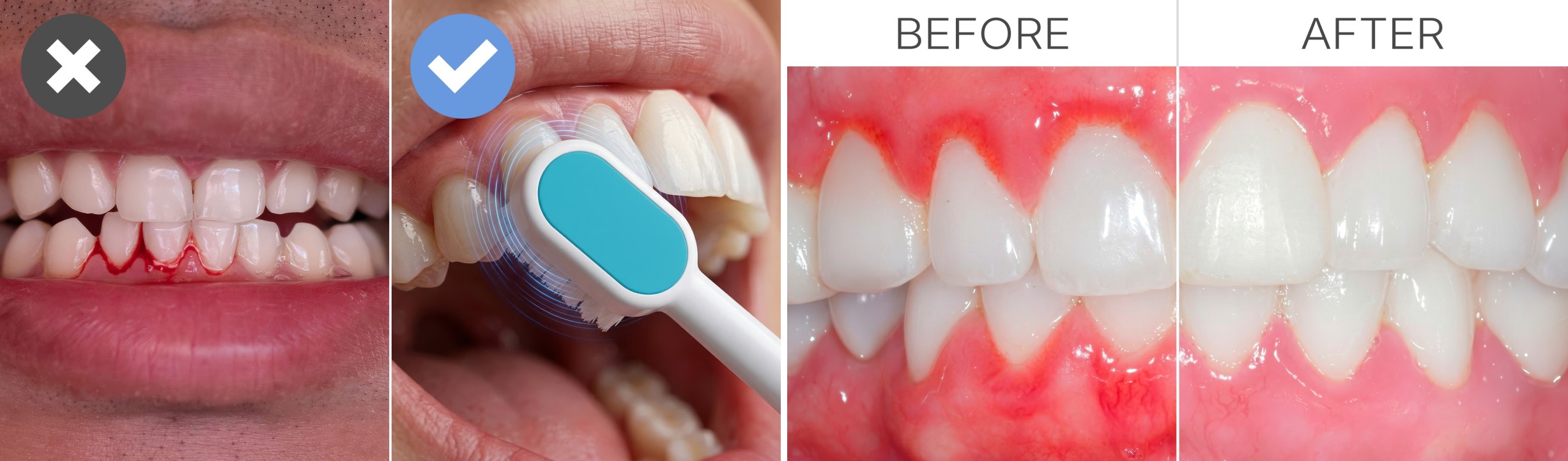 Side-by-side comparison of unhealthy and healthy gums with brushing improvement