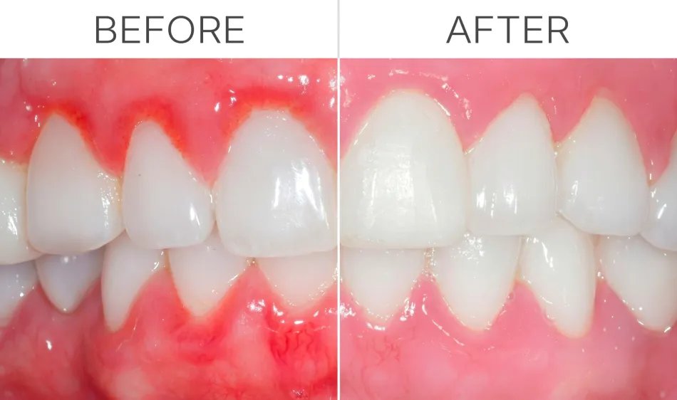 Real-World Experience With Great Gums