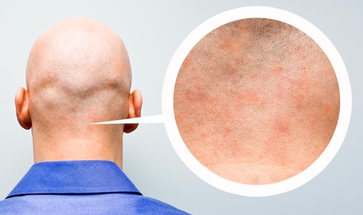 Diagram showing bald head and skin surface for electric shaver comparison