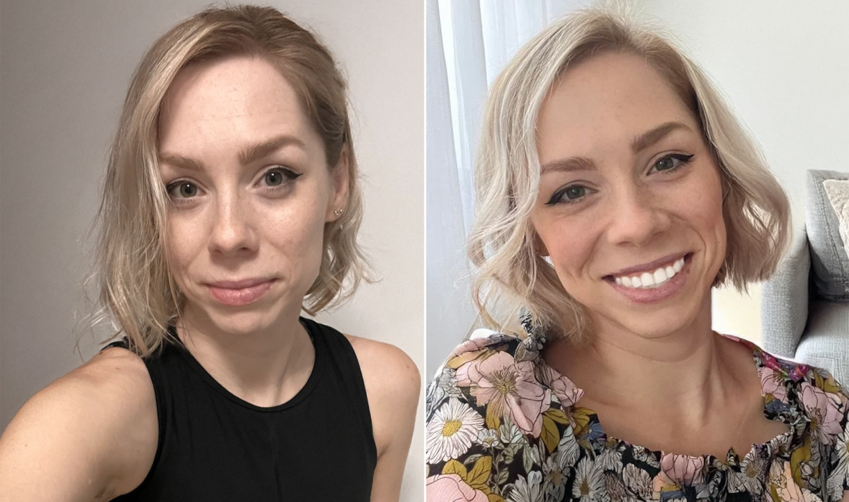 Before and after selfies showing Laughland whitening results
