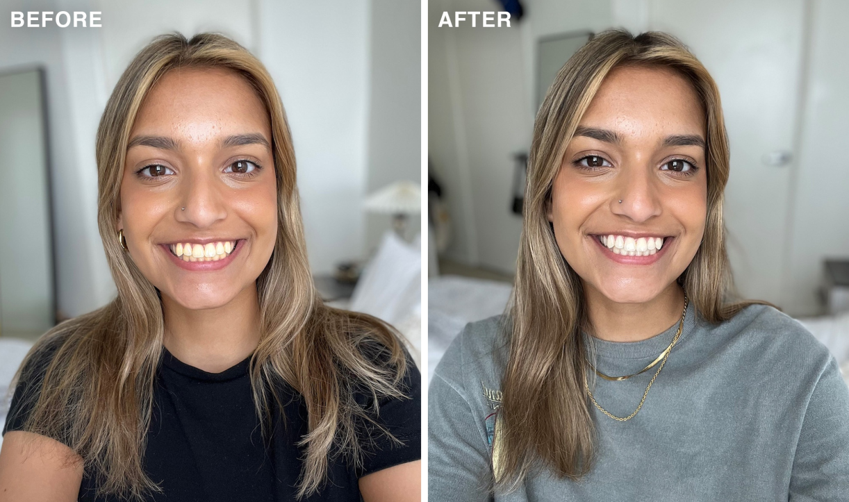A woman smiles in a before and after comparison photo showing whiter teeth