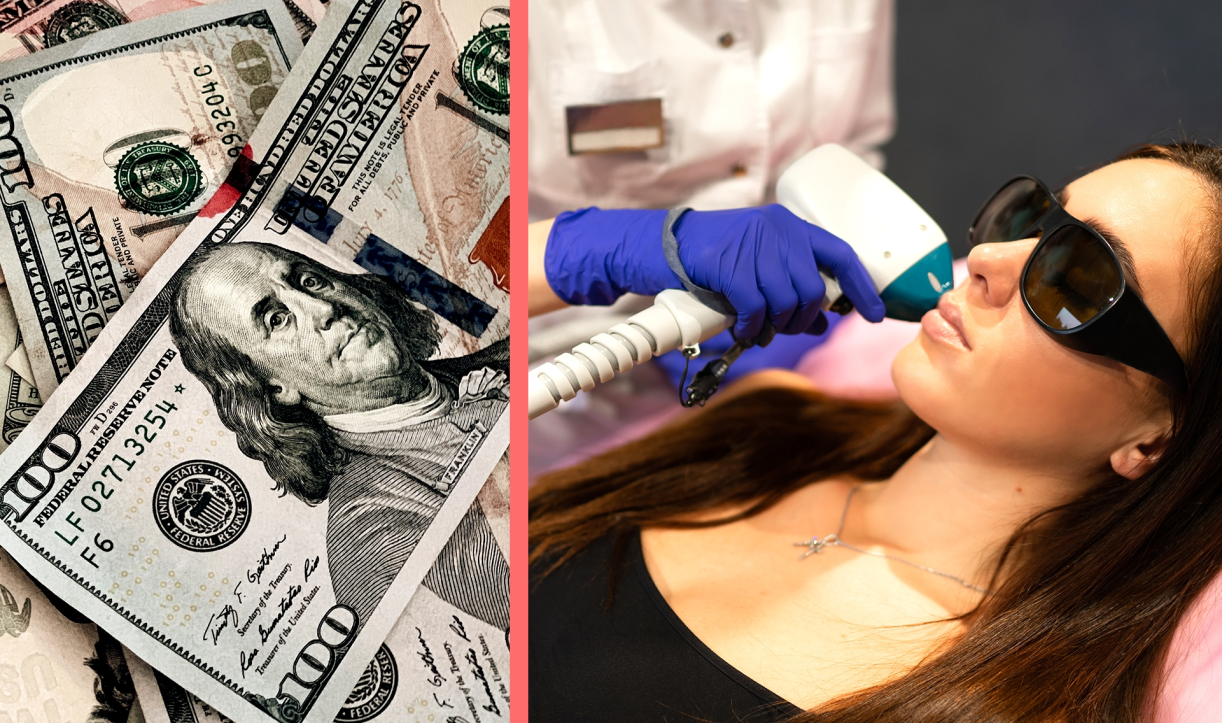 Before and after comparison of upper lip hair removal