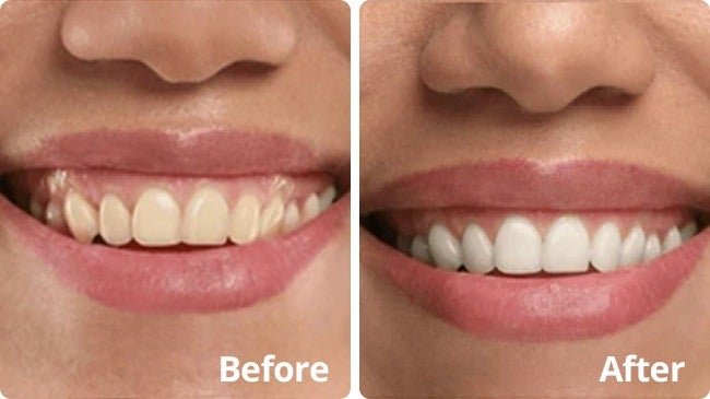 PurelyWHITE Deluxe vs. Whitening Strips