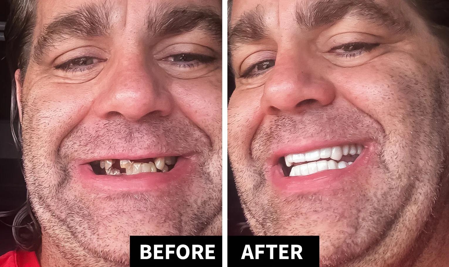 Before-and-after photo of a man showing his teeth before and after using snap-on veneers