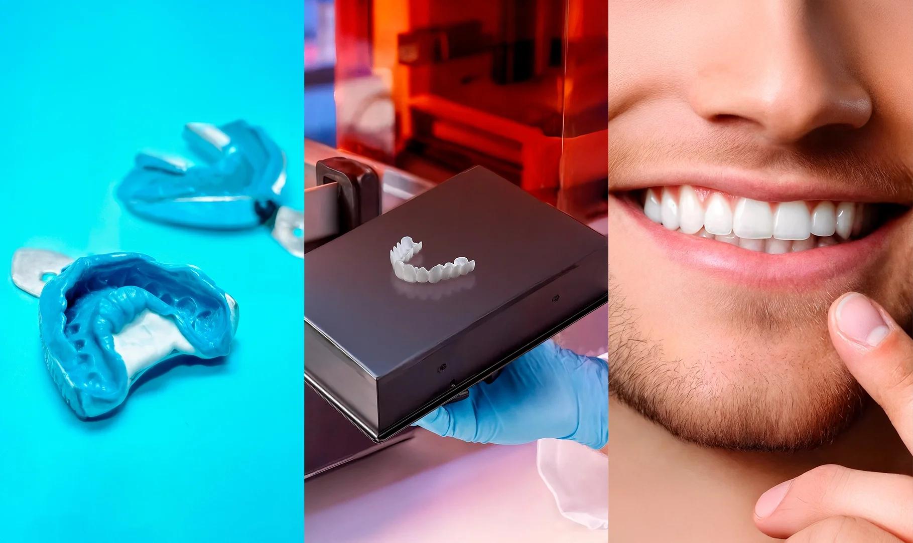 Three-panel image showing impressions, 3D-printed veneer, and a smiling mouth with veneers
