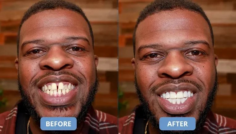 Wide product shot of Shiny Smile Veneers on a white background